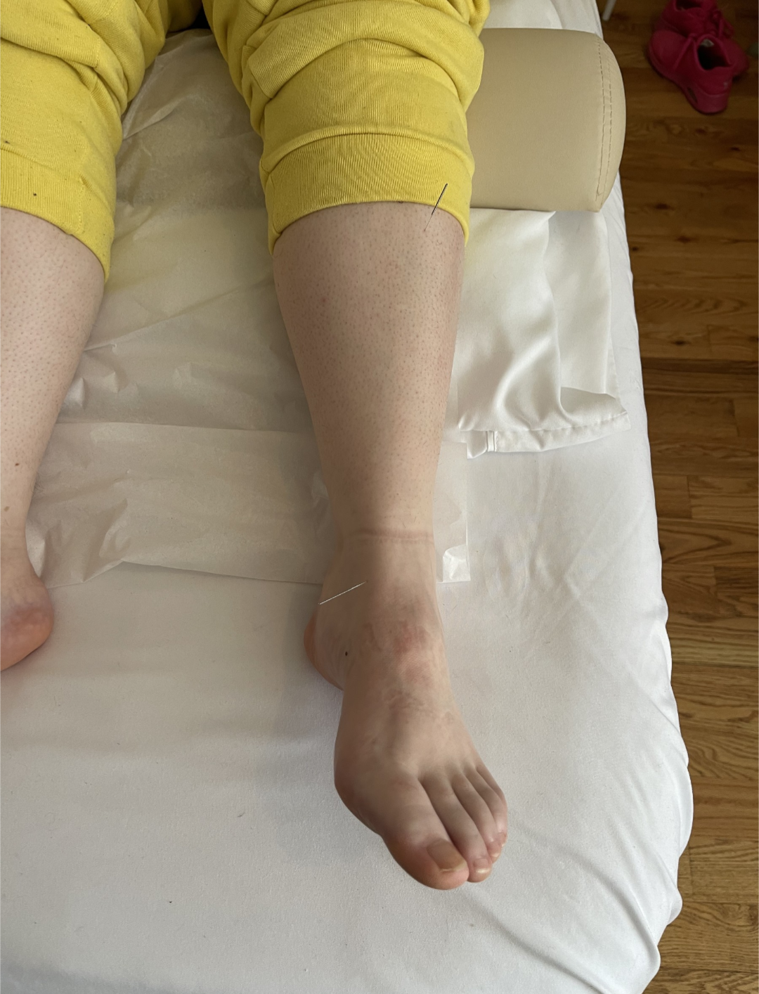 PJs pale bare legs are on the massage table, she hads several acupuncture needles in