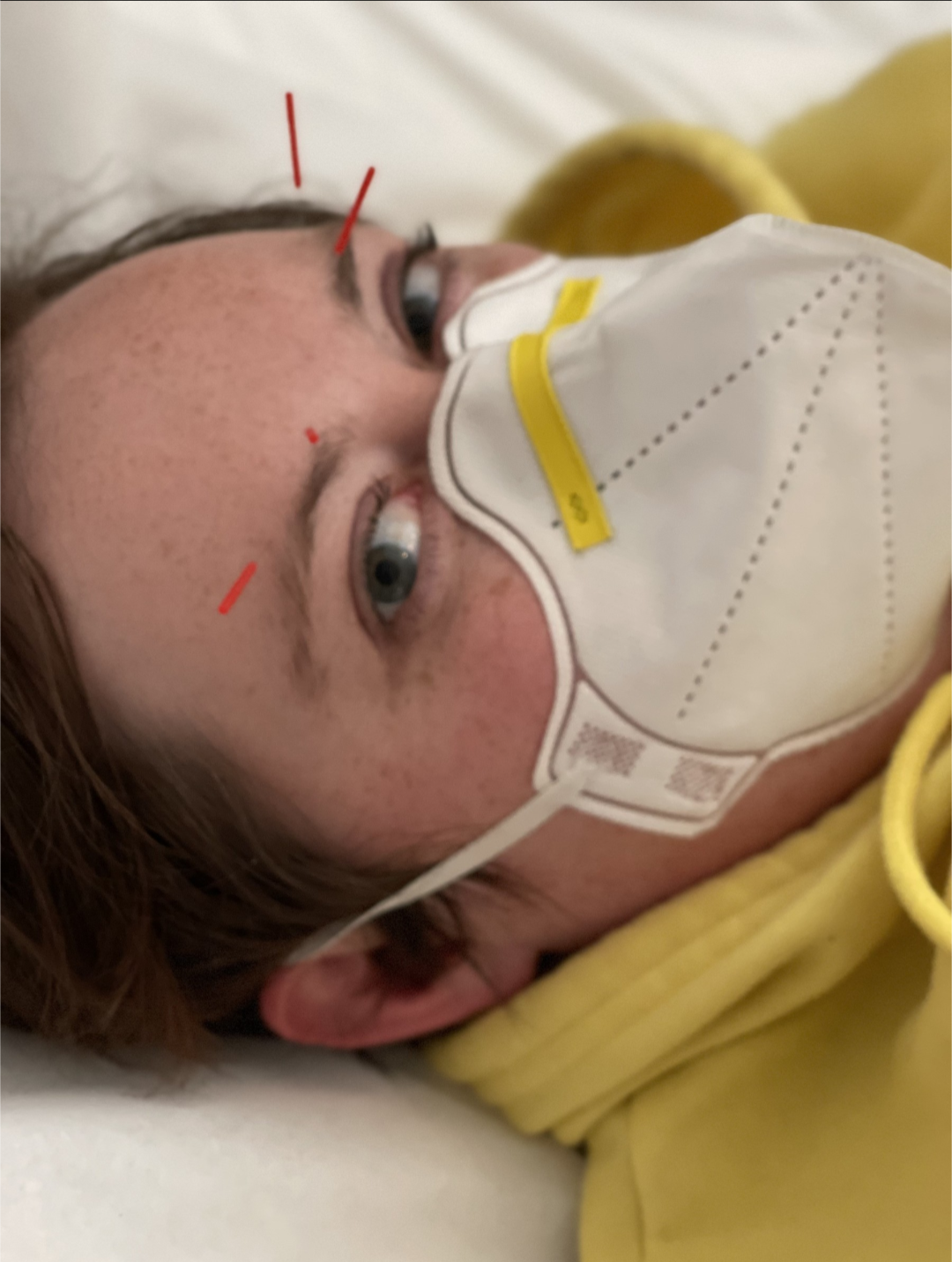 close up shot of PJ's face, she is wearing a yellow hoodie and has four red acupuncture needles in her bro